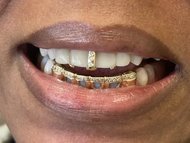 special custom gold grill with diamonds