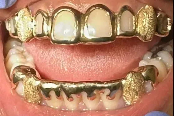 custom gold grillz