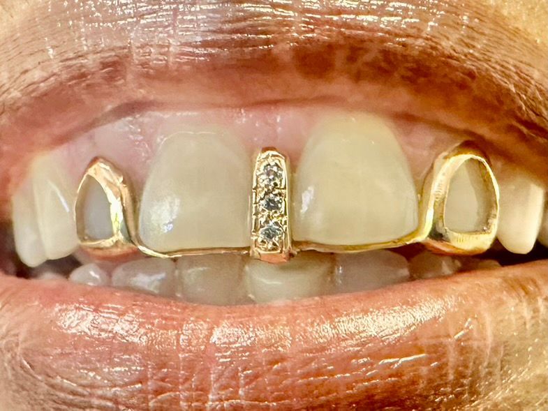 gold grill with diamond