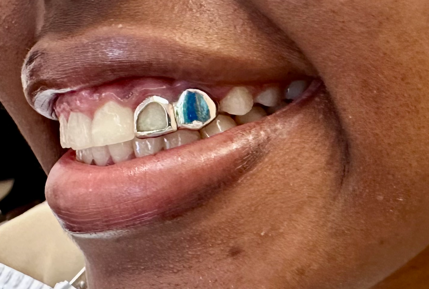 silver tooth cap with gem