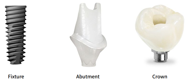Dental implant components: fixture, abutment, and crown.