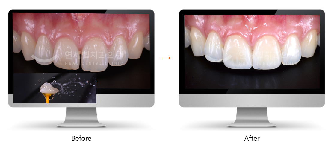Before and after photos of teeth; improvement in appearance, color, and alignment.