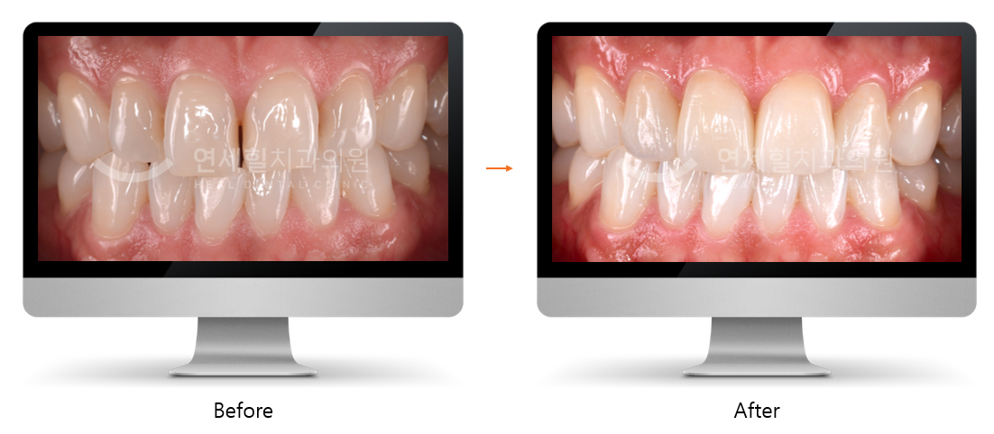 Comparison of teeth before and after cosmetic dental work; shows whiter, straighter teeth.