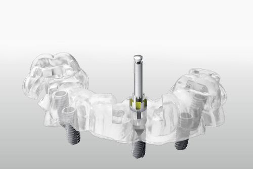 Clear dental implant guide with metal posts in place.