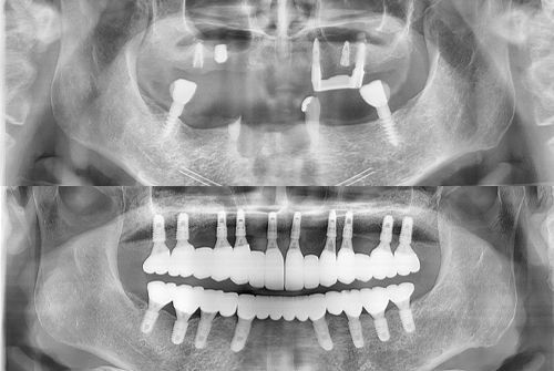 Dental X-ray: Upper and lower jaws showing multiple dental implants and prosthetic teeth.