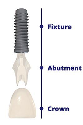 Diagram of a dental implant with fixture, abutment, and crown components.