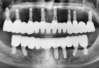 Dental X-ray: full mouth view of upper and lower jaw with numerous dental implants supporting artificial teeth.