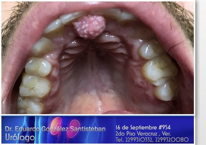 DR. EDUARDO GONZÁLEZ SANTISTEBAN - Cáncer de tumoraciones urogenitales