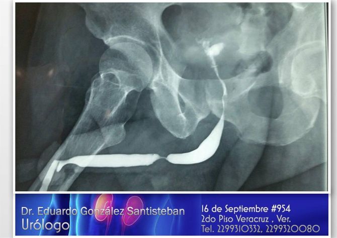 DR. EDUARDO GONZÁLEZ SANTISTEBAN - Cáncer de próstata