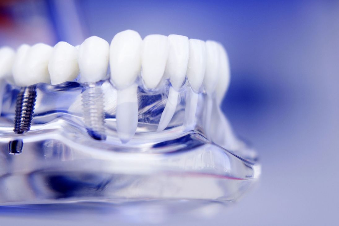 Allineatore dentale trasparente con denti bianchi su sfondo blu