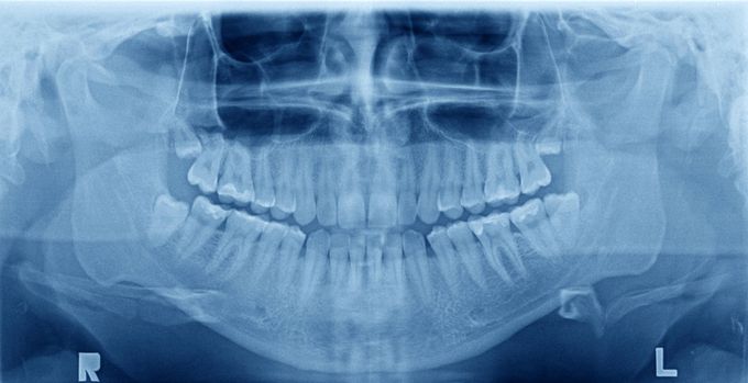 Radiografia dentale panoramica che mostra i denti superiori e inferiori e le ossa mascellari.