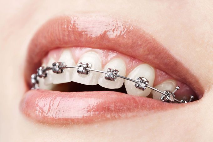 Primo piano di una bocca sorridente con apparecchio metallico sui denti.