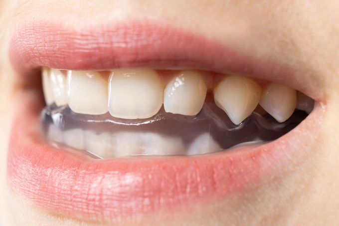 Primo piano di una bocca sorridente con denti mancanti e incisivi superiori visibili.