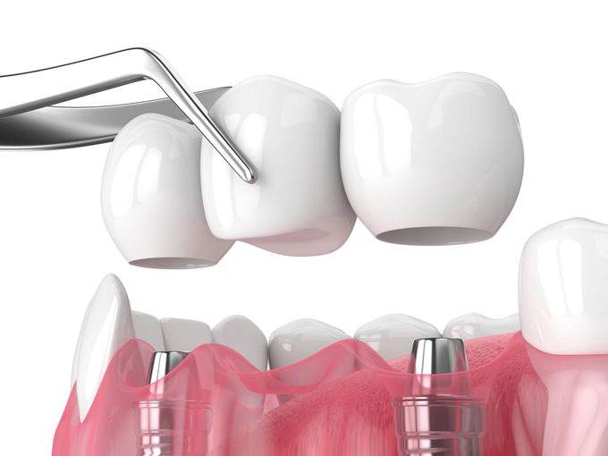 Illustrazione 3D di una pinza odontoiatrica che estrae un dente bianco da gengive rosa.