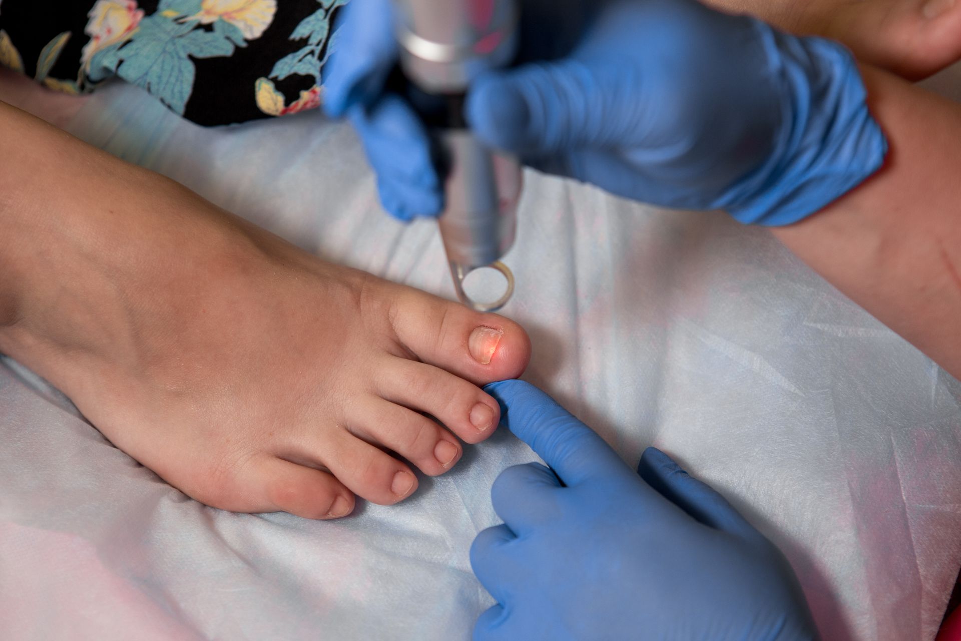 A laser device targets a toenail as a specialist performs treatment for a fungal nail condition. A laser device targets a toenail as a specialist performs treatment for a fungal nail condition.