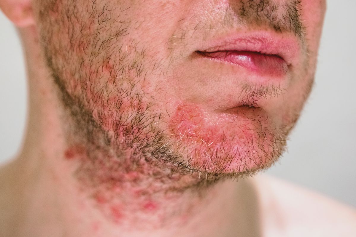 Explore a dermatite seborreica, comumente conhecida como caspa, suas causas potenciais, fatores de risco e tratamentos recomendados para aliviar os sintomas.