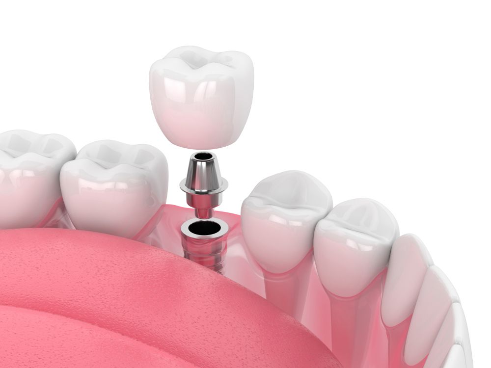 A Dental Implant — Teeth Whitening in Newcastle, NSW