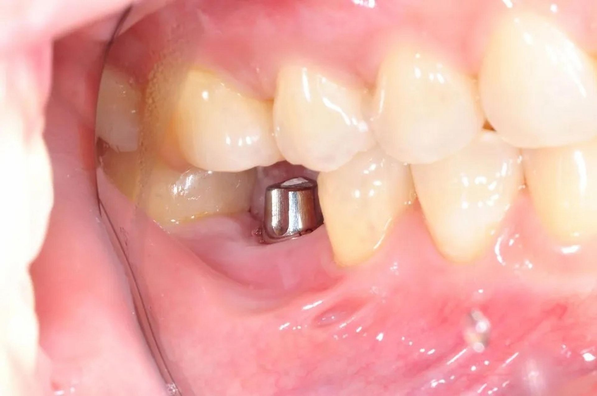 Dental Implants In Newcastle With Visible Single Tooth Implant Fixture