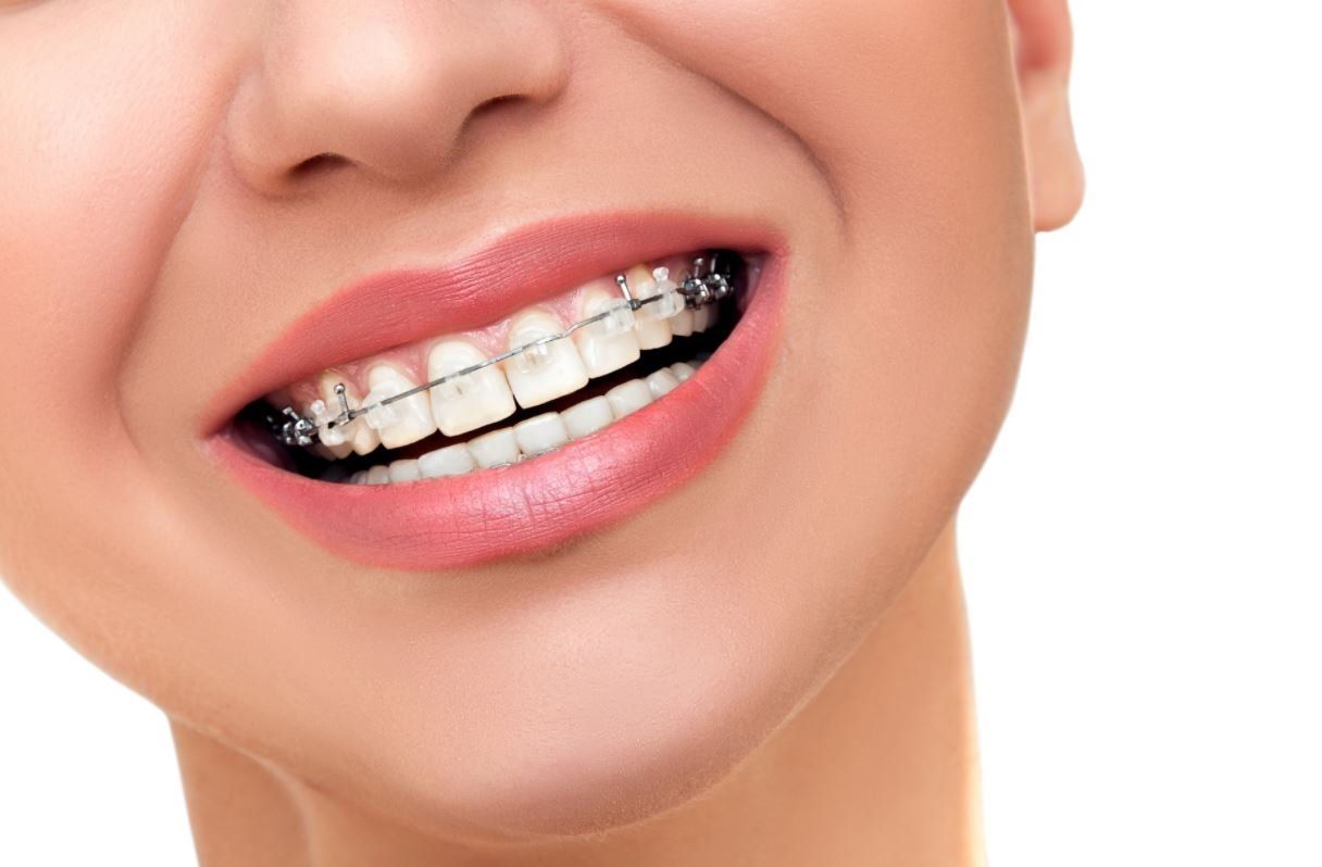 Open Mouth Showing Fastbraces — Braces in Newcastle, NSW