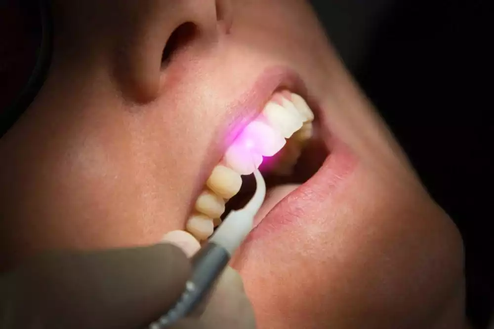 Tooth Filling Ultraviolet Lamp — Laser Dentistry in Newcastle, NSW