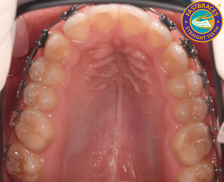 Close up Dental Braces on Teeth — Braces in Newcastle, NSW