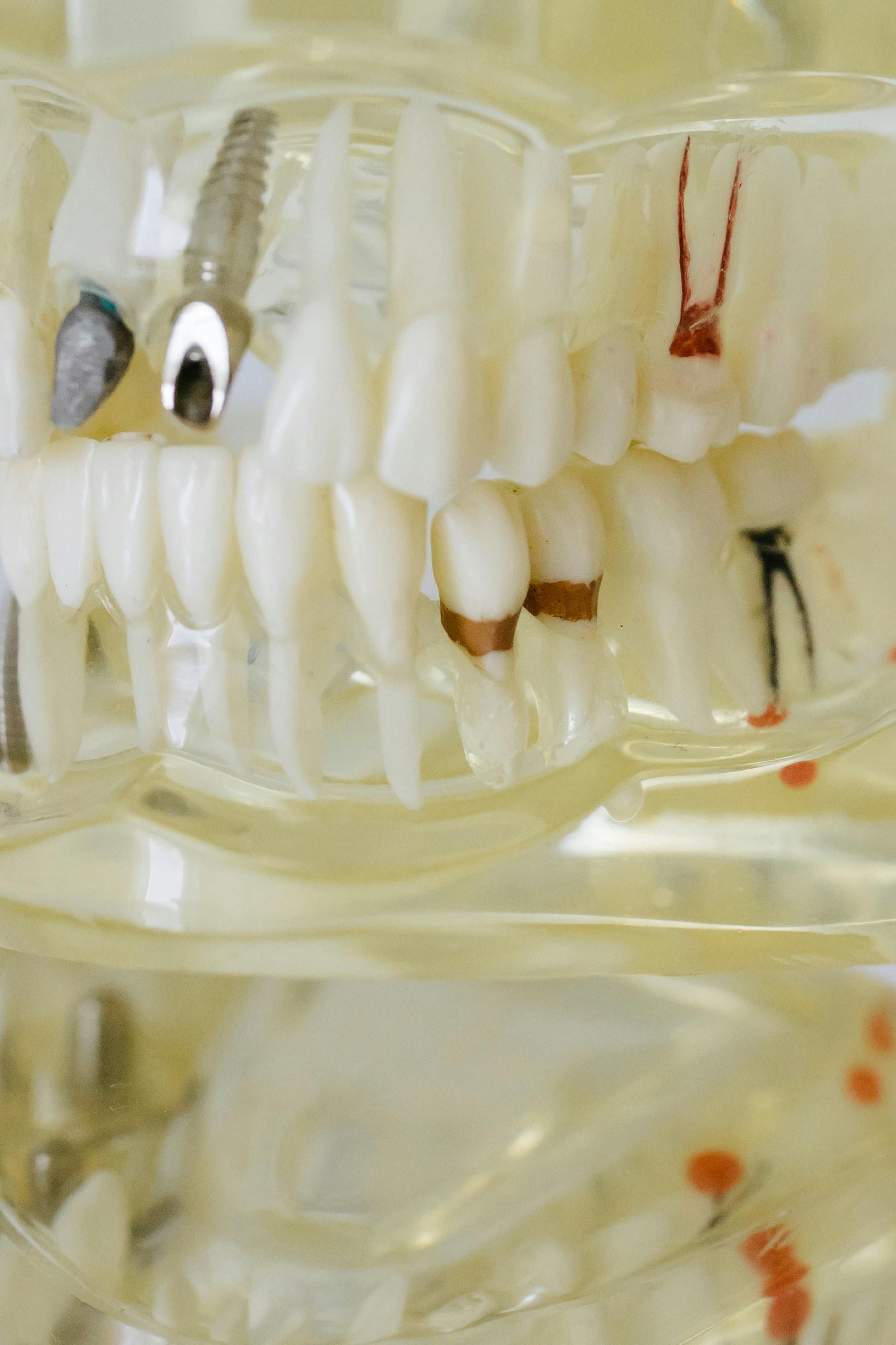 Dental implants on a clear model