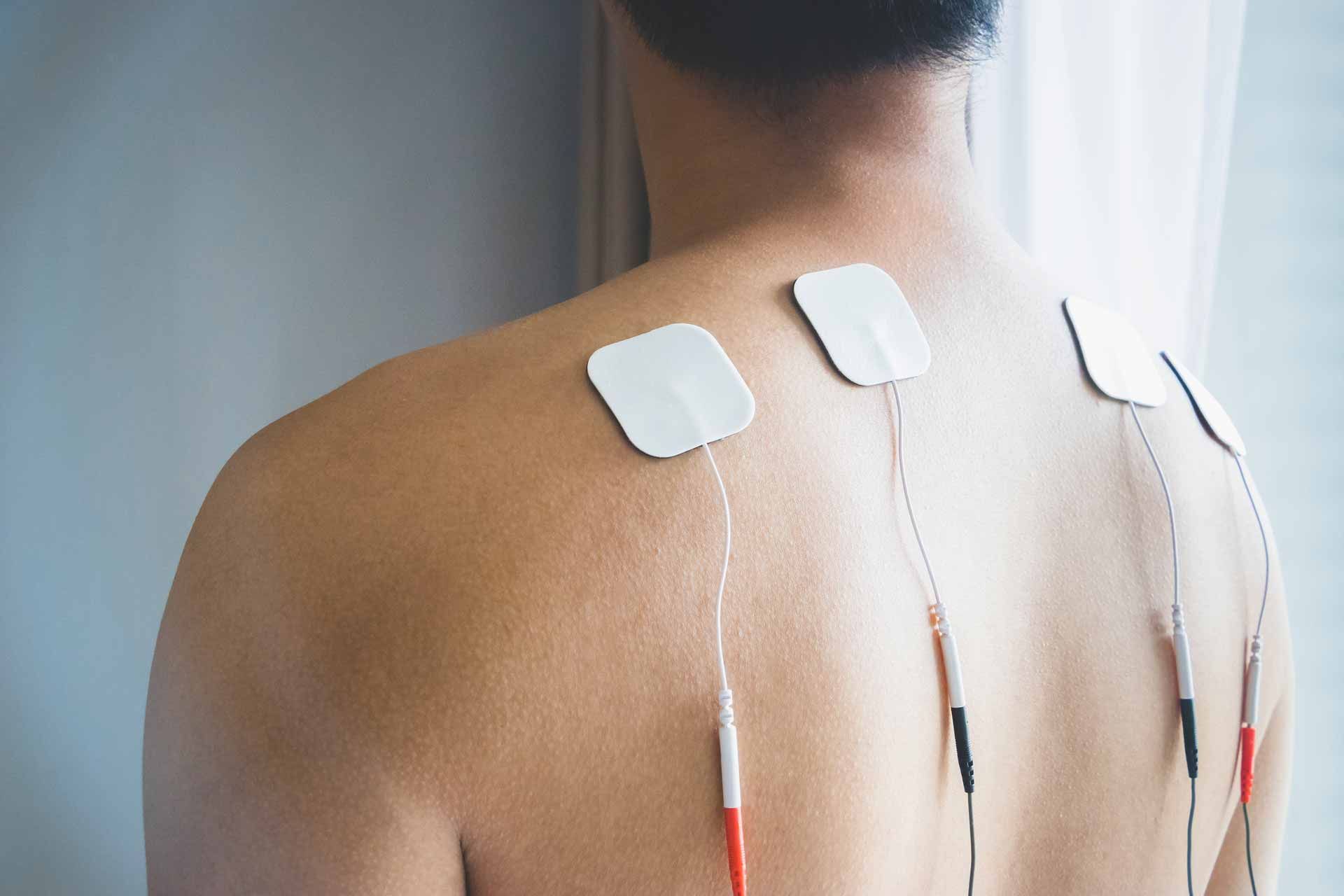 Back of person with adhesive electrodes attached to upper back for electrical stimulation therapy