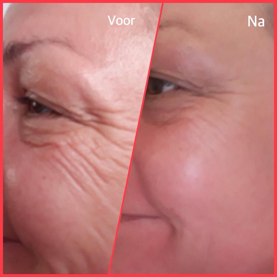 Cupping Orangerie Agnes Raskin – cupping en FIT Bodywrap Lommel - resultaten