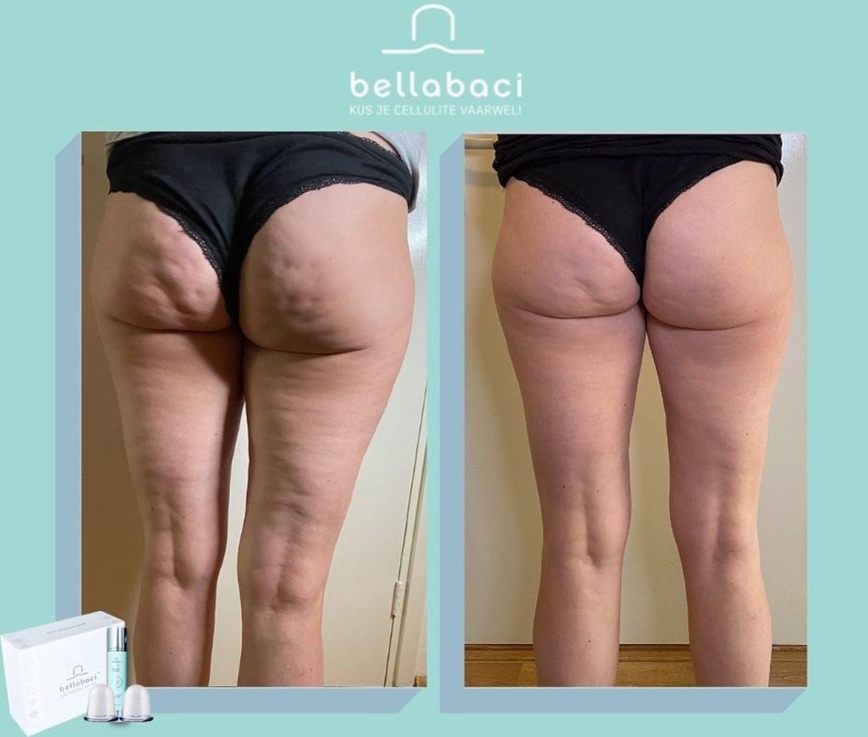 Cupping Orangerie Agnes Raskin – cupping en FIT Bodywrap Lommel - resultaten