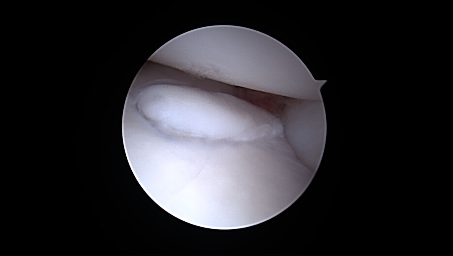 Vue arthroscopique d'une articulation du genou ; cartilage blanc et structures environnantes visibles.