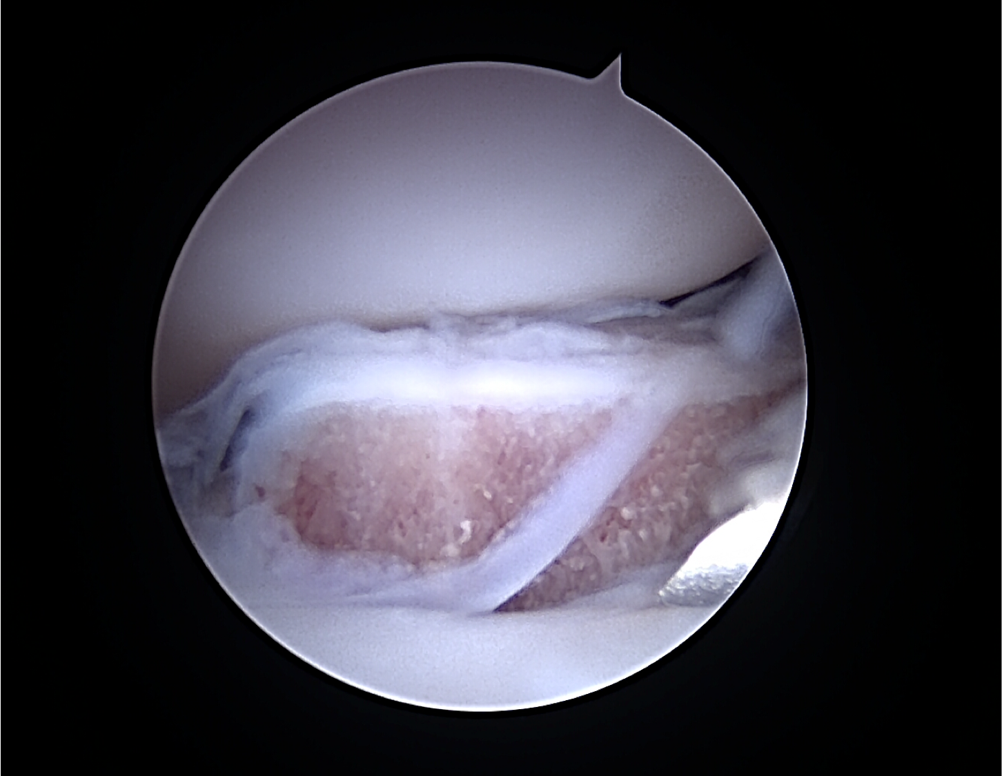 Vue arthroscopique d'une articulation du genou ; ligaments blancs et tissus rouges/beige.