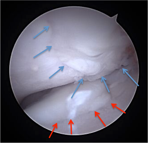 Vue arthroscopique de l'intérieur du genou ; les flèches bleues indiquent un tissu lisse, les flèches rouges une surface plus rugueuse.