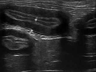 Échographie d'une coupe transversale de l'intestin. Les différentes couches sont visibles et présentent un aspect épais et œdémateux.