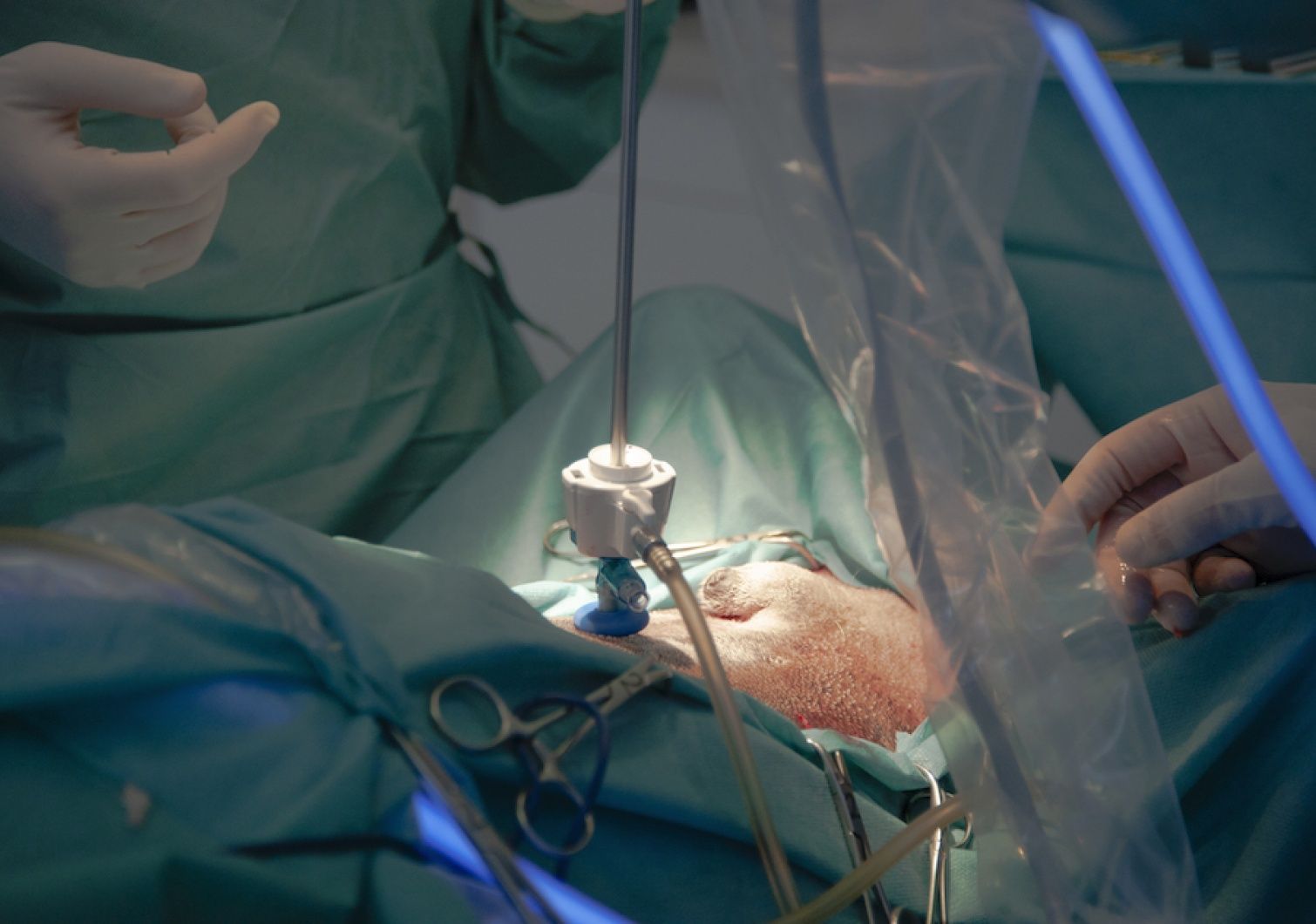 Intervention chirurgicale : un laparoscope est inséré dans l’abdomen d’un patient. On aperçoit les instruments chirurgicaux et des mains gantées.