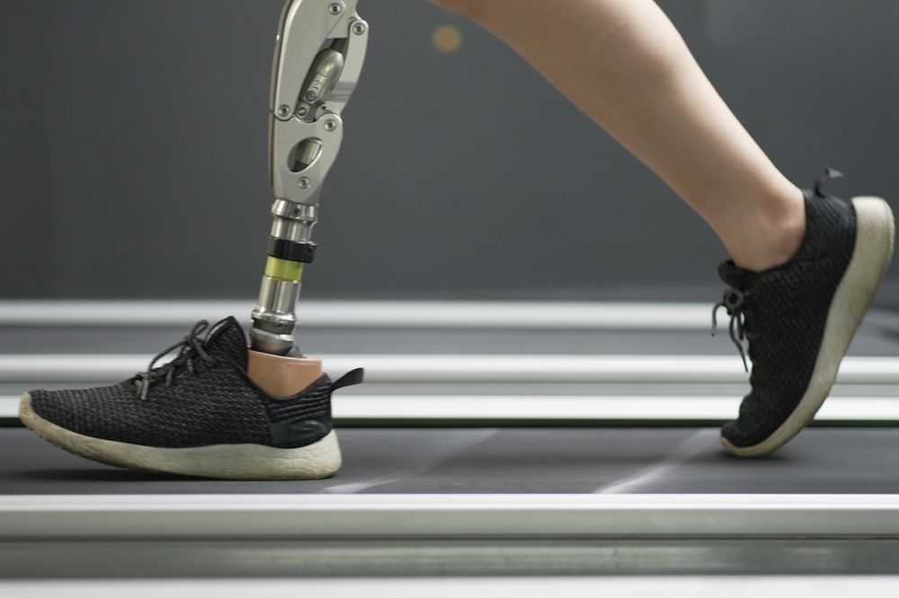 Person with a prosthetic leg walks on a treadmill wearing black sneakers.