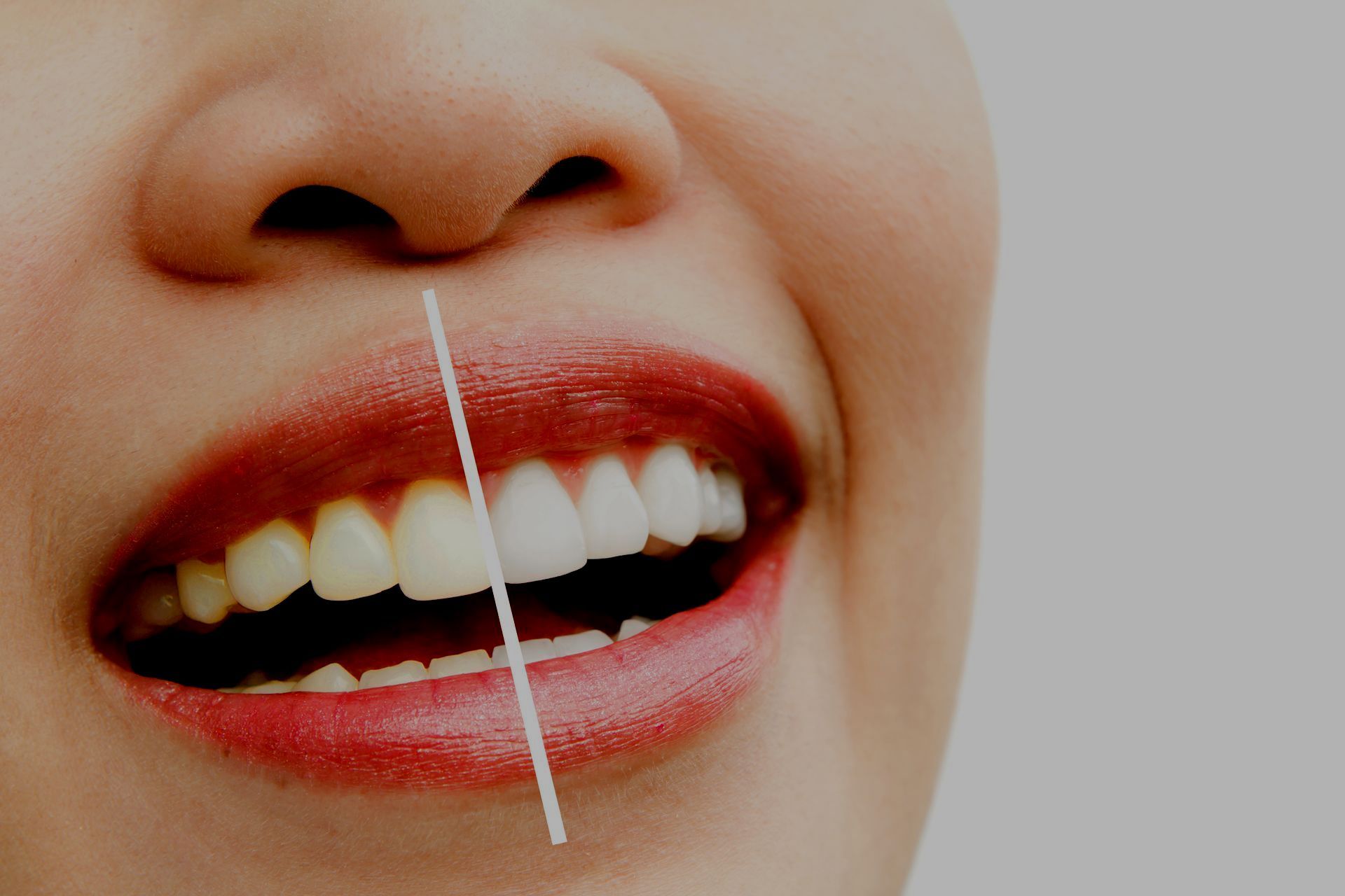 Diseño de sonrisa