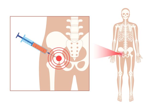 b12 injection site buttocks Sacroiliac Joint Injections for Low Back And Buttock Pain Mecobalamin Size:1000 mcg/ml - 30 ml (Pack of 5) doctors office that gives