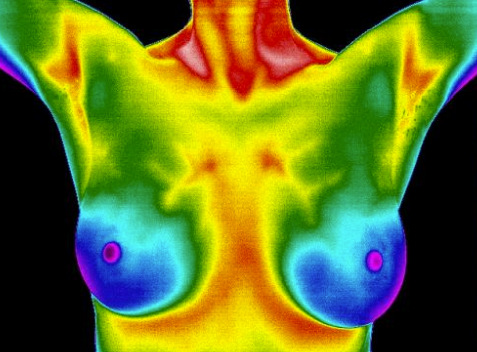 Breast Thermography