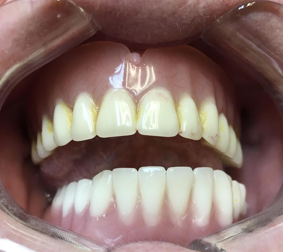 after full denture