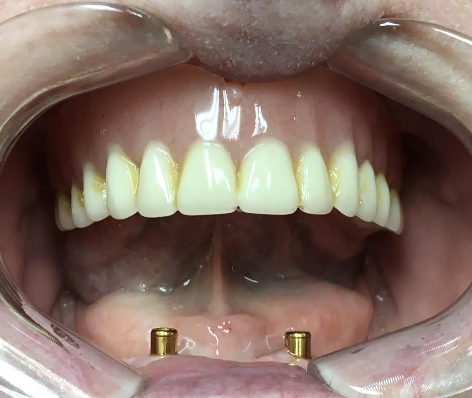 before full denture