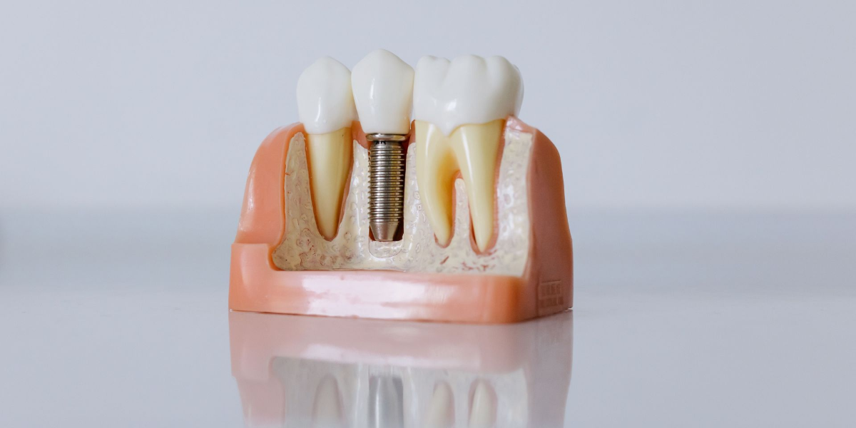 Dental implant model with two artificial teeth and a visible metal post in gum tissue model