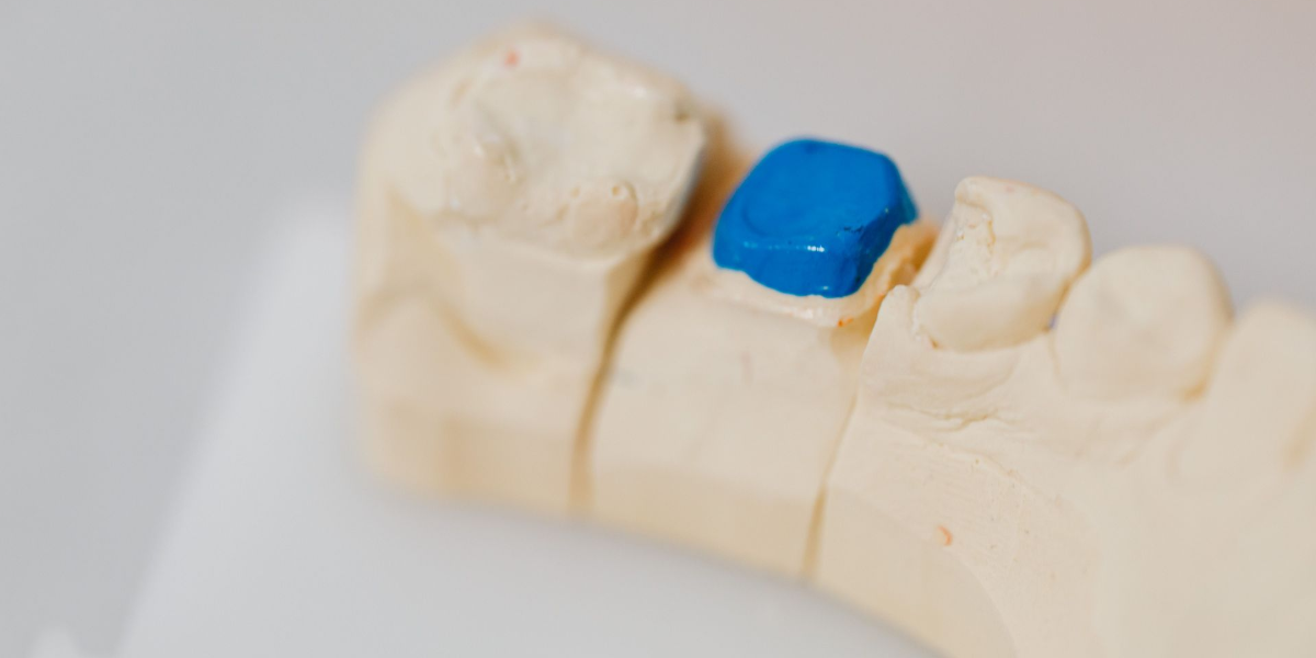 Dental model with a blue tooth restoration between cream-colored teeth
