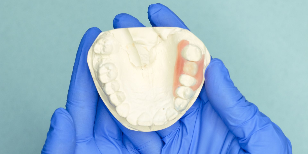 Dental model with a blue tooth restoration between cream-colored teeth