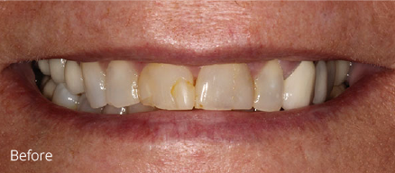 A close up of a person 's teeth before a dental treatment.