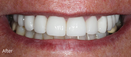 A close up of a person 's mouth with white teeth.