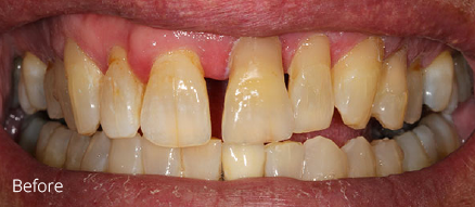 A close up of a person 's teeth before a dental treatment.