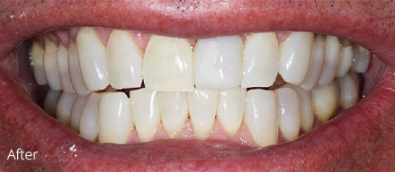 A close up of a person 's mouth with white teeth.
