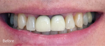 A close up of a person 's teeth before dental work