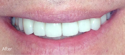 A close up of a man 's smile with white teeth.