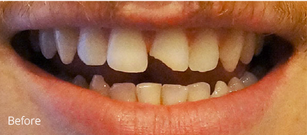 A close up of a person 's mouth with a broken tooth.
